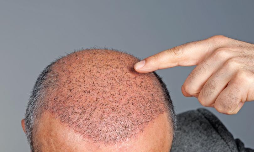 Пересадка волос в Турции